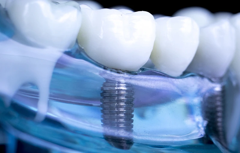 Implant zębowy