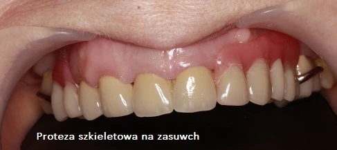 Proteza szkieletowa na zasuwach